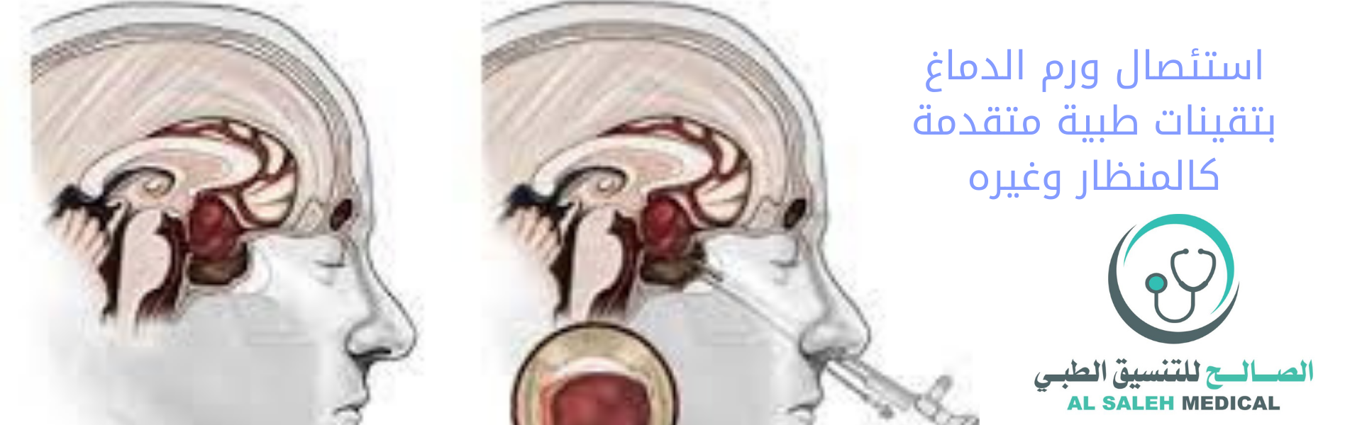  علاج الورم الدموي في الهند بعيدا عن الجراحة